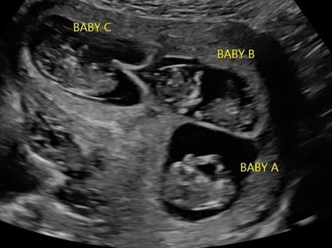 An early first trimester ultrasound with triplets. 10 Week Ultrasound, Pregnant With Triplets, Baby Ultrasound Pictures, Triplets Pregnancy, Pregnancy Ultrasound, Bump Pictures, Multiples Baby, Baby Ultrasound, Triplet Babies