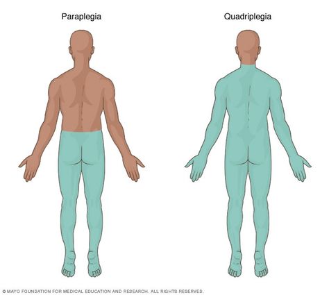 Illustration showing the area of the body affected by paraplegia and quadriplegia Spinal Cord Injuries, Neurological System, Leg Injury, Lower Limb, Spinal Cord, Mayo Clinic, Care Plans, Personal Injury, Couples Goals