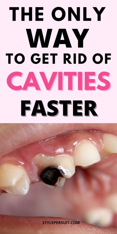 Getting rid of cavity and tooth decay can be a big problem but there are remedies to alleviate pain and slow down tooth decay until you can see a dentist. Home Remedies For Cavities, Cavity Remedy, Fix Teeth, Tooth Cavity, Tooth Decay Remedies, Tooth Repair, Teeth Whitening Remedies, Teeth Whitening Diy, Teeth Health