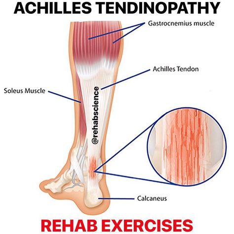 💥𝐀𝐜𝐡𝐢𝐥𝐥𝐞𝐬 𝐓𝐞𝐧𝐝𝐢𝐧𝐨𝐩𝐚𝐭𝐡𝐲💥 ——— 👣Achilles tendinopathy describes a condition in which the tendon that connects the calf muscles (gastrocnemius… Achilles Tendinopathy, Sports Injury Prevention, Soleus Muscle, Gastrocnemius Muscle, Sports Injury, Calf Muscles, Injury Prevention, Muscles, Conditioner