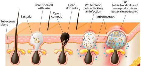 How to Get Rid of Cystic acne (Cyst pimples), Quickly and Naturally - Era Organics Cystic Acne Remedies, Acne Vulgaris, Healing Clay, Natural Acne Remedies, Natural Acne, Home Remedies For Acne, Types Of Acne, Acne Causes, Cystic Acne