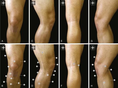 Knee Anatomy and Biomechanics of the Knee | Musculoskeletal Key Knees Anatomy, Knee Reference, Knees Reference, Anatomy Knee, Knee Drawing, Knee Anatomy, Leg Reference, Technical Art, Leg Anatomy