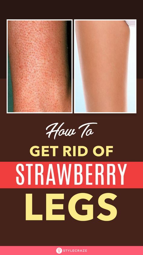 How To Get Rid Of Strawberry Legs – 3 Simple Steps To Soft And Beautiful Legs #BeautyTips #SkinCare #StrawberryLegs #Tips #Tricks Permanent Facial Hair Removal, Back Hair Removal, Strawberry Legs, Underarm Hair Removal, Remove Unwanted Hair, Permanent Hair Removal, Camouflage Makeup, Unwanted Facial Hair, Remove Hair