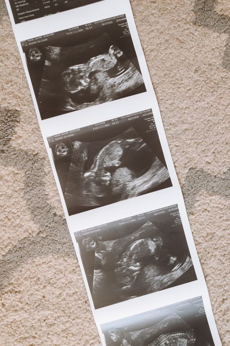 For those of you who haven't already been over to my Instagram to hear the news, press play to find out the gender of Baby Hallak #2! 12 Week Ultrasound Pictures, 10 Week Ultrasound Pictures, 12 Weeks Pregnant Ultrasound, 5 Weeks Pregnant Ultrasound, Boy Ultrasound Pictures, Ultrasound Picture Ideas, Boy Ultrasound, 16 Weeks Pregnant Ultrasound, Pregnant Picture