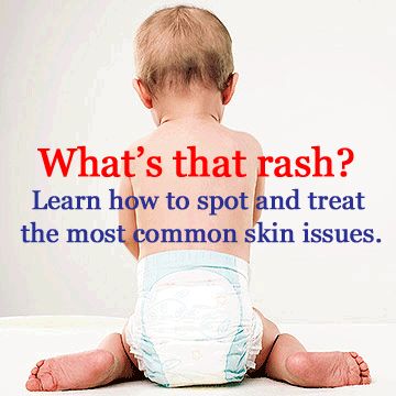 From diaper rash to hives, get expert tips about how to detect and heal skin irritations. http://www.parents.com/baby/health/rashes/rashes/?socsrc=pmmpin130110PTTRashes Types Of Rashes, Skin Rashes, New Parent Advice, Childrens Health, Newborn Care, Baby Time, Healthy Babies, Everything Baby, Skin Issues