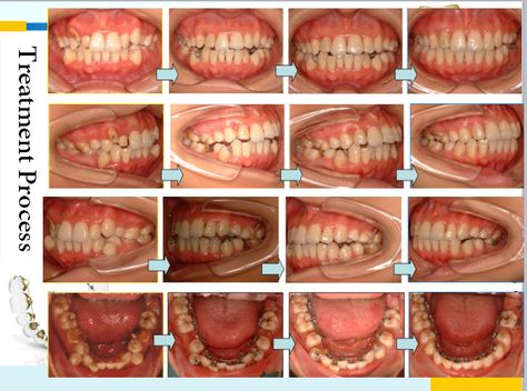 Lingual Braces, Teeth Braces, Braces, Step By Step