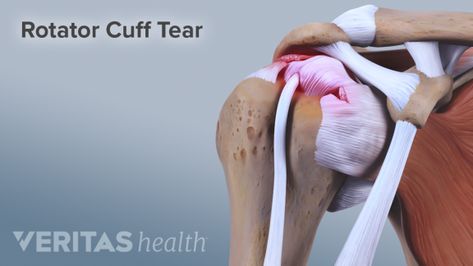 If you sleep on your side every night, you may be putting yourself at risk for tendinitis in your shoulder's rotator cuff. Rotator Cuff Injury Exercises, Shoulder Exercises Physical Therapy, Shoulder Muscle Pain, Rotator Cuff Pain, Lower Back Pain Remedies, Shoulder Anatomy, Severe Lower Back Pain, Rotator Cuff Surgery, Rotator Cuff Exercises