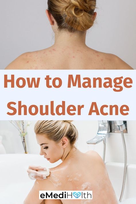 Acne forms due to the clogging of pores and compromised skin health, both of which can occur as a result of multiple factors. Therefore, it is vital to take good care of your skin internally and externally. The following lifestyle tips are helpful in the management of acne breakouts and lower their frequency: Shoulder Acne, Tips For Acne, Natural Acne, Simple Lifestyle, Acne Solutions, Simpler Lifestyle, Acne Breakout, Lifestyle Tips, Skin Health