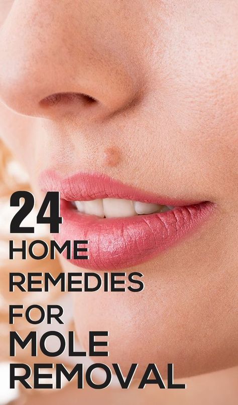 Is your beauty being destroyed because of moles? Mole removal may be quite painful,follow these effective home remedies for mole removal which are safe & easy. What Causes Warts, Cancerous Moles, Warts On Hands, Red Moles, Warts On Face, Skin Moles, Skin Growths, Mole Removal, Get Rid Of Warts