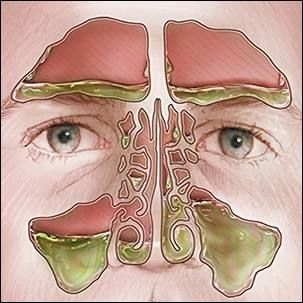 Nasal mucus color: What does it mean? Color Of Mucus Meaning, Yellow Mucus From Nose, Mucus Color, Yellow Mucus, Q And A, Health Questions, Sinus Infection, My Grandson, Bacterial Infection