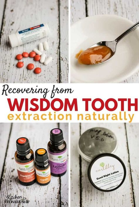 I got 3 wisdom teeth removed without general anesthesia! Here are all my tips for natural pain relief for wisdom teeth removal recovery with no pain killers. #naturalhealth #wisdomteeth #dentist #homeopathy Wisdom Teeth Recovery Food, Getting Wisdom Teeth Out, Wisdom Teeth Removal Recovery, Wisdom Teeth Food, Wisdom Teeth Pain Relief, Wisdom Teeth Recovery, Tooth Pain Remedies, Wisdom Teeth Pain, After Wisdom Teeth Removal