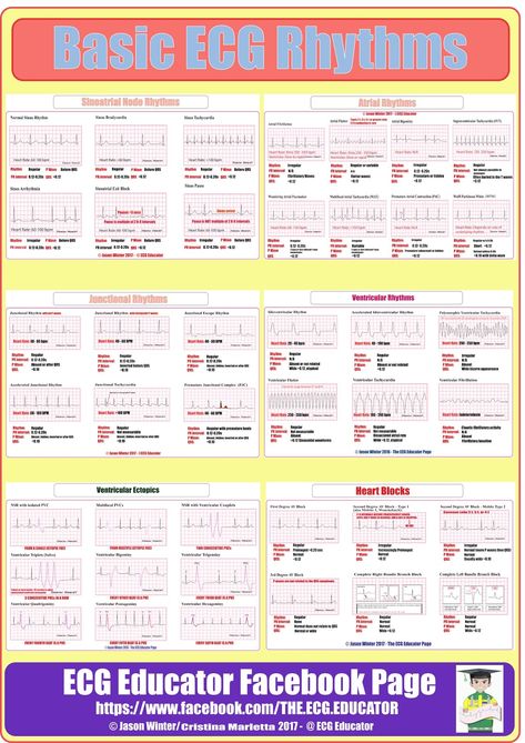 EKG Basics Rate Calculation #MedStudent #EKG #Basics #HeartRate #Rate #Intervals #EKGBasics #ECGEducator Ekg Nursing, Ekg Rhythms, Ekg Interpretation, Ecg Interpretation, Cardiac Rhythms, Nursing Information, Nurse Study Notes, Nursing Mnemonics, Cardiac Nursing