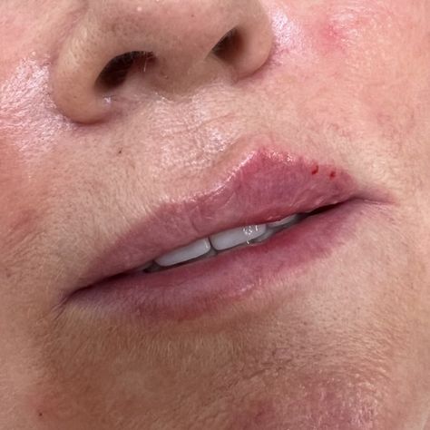 🤩 Just too at the incredible lift you can get using dermal filler!!! 🤩 I had to stop and take a picture 📷 #aestheticsessex #aestheticsbenfleet #lipfilleressex #lipfillerbenfleet #dermalfillerbenfleet #dermalfilleressex #benfleet #essex #russianlips #russianliosbenfleet #russianlipsessex #lipenhancement #lipenhancementbenfleet #lipenhamcementessex #lipaugmentation #lipaugmentationessex #lipaugmentationbenfleet #aestheticsbykatie #aestheticsbykatiexx #aestheticsbykatiebenfleet #naturallipfil... Lips Inspiration, Lip Blush, Lip Augmentation, Lip Enhancement, Lip Injections, Dermal Fillers, Lip Fillers, Take A Picture, April 20