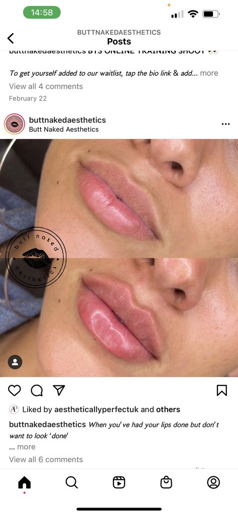 Lip Flip Vs Filler, Lips Ideas, Mommy Makeover Surgery, Heart Shaped Lips, Lips Inspiration, Botox Lips, Lip Combos, Lip Filler, Mommy Makeover