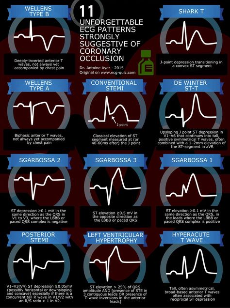 Paramedic Science, Paramedic Study, Cardiac Anatomy, Cardiology Nursing, Paramedic School, Nursing Information, Medical Notes, Cardiac Nursing, Critical Care Nursing