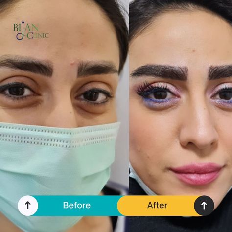 Transforming confidence, one brow at a time! 🌟 Witness the magic of eyebrow transplant and the difference it makes. #BeforeAndAfter #EyebrowTransformation #EyebrowTransplant #BrowGoals #TransformationTuesday #NewLook #ConfidenceBoost #BeautyJourney #NaturalBrows #CosmeticSurgery #SelfCare #glowup Eyebrow Transplant, Natural Brows, Transformation Tuesday, Hair Transplant, Confidence Boost, Cosmetic Surgery, Eyebrows, The Magic, New Look