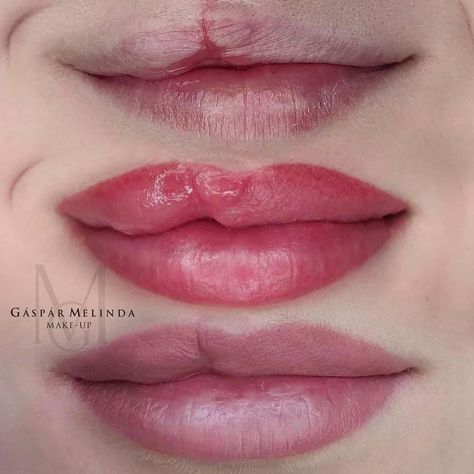 Cleft Lip Scar, Cleft Lip Tattoo Ideas, Lip Scars Reference, Facial Scar Reference, Micropigmentation Lips, Scar Drawing, Lip Pmu, Scar Makeup, Covering Acne