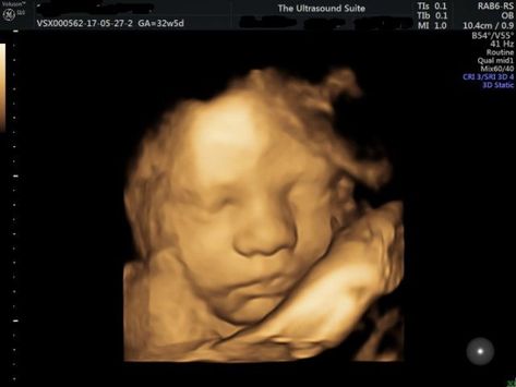 4D ultrasounds can be done at various times during your pregnancy, but the best time to do a 4D well-being scan in Aylesbury is between 20 and 22 weeks of your pregnancy. 4d Ultrasound Pictures, 22 Weeks Pregnant, 3d Ultrasound, Easy Labor, 4d Ultrasound, Ultrasound Technician, Gestational Age, To Be Wanted, Ultrasound Pictures