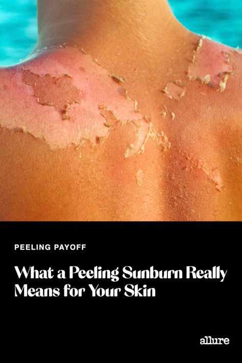 Best Lotion For Sunburn, Skin Peeling From Sunburn, Heal Sunburn Fast, Sunburn On Face, Sunburn Blisters, Sunburned Lips, Skin Peeling On Face, Burn Remedy, Sunburn Peeling