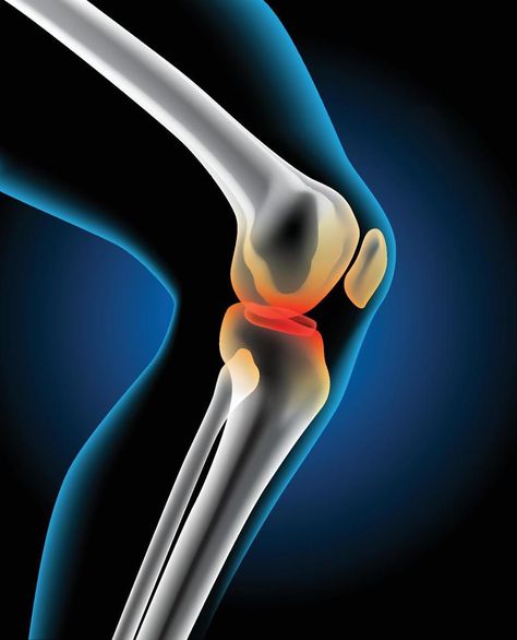 The picture shows an injury to the knee joint. Joints Pain Remedy, Knee Problem, Pain Relief Remedies, Physical Therapy Exercises, Injury Recovery, Knee Pain Relief, Knee Injury, Knee Pain, Flat Design