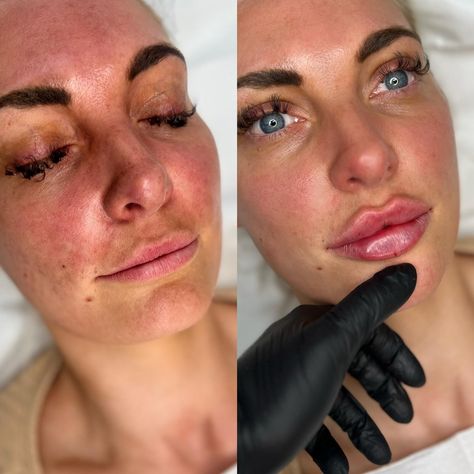 How many mls do you think she had?

The misconception of fillers is that you need to pack the lip to make it plump and give it shape. But this couldn't be further from reality, Natalies signature Russian Kiss Contour uses less than 2ml to create height and lift and some clients 0.8ml is enough.

It's not about more filler it's about the technique! Lip Filler 2ml, Russian Lip Filler Technique, Russian Kiss, Russian Lips Filler, Lip Goals, Cupids Bow Lips, Russian Lips, Juvederm Lips, Thick Lips