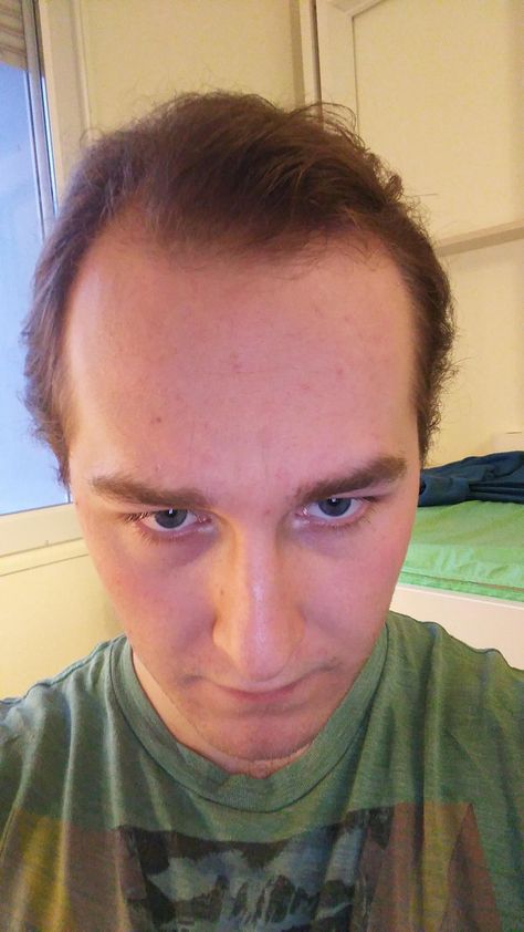 Receding hairline?? Does it look like I'm going bald?? #hair #hairstyle #hairstyles #beauty Messed Up Hairline, Mcdonalds Hairline, Buzzcut Receding Hairline, Celebrity Hair Colors, Going Bald, Receding Hairline, Bald Hair, Women Makeup, Hair And Beauty