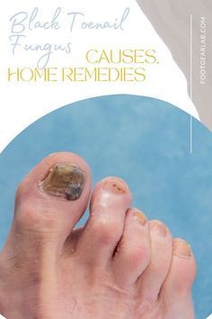 Toenail Fungus (Symptoms, Causes and Support Strategies) It is a fungal infection that may spread to the skin surrounding the affected toe and other toenails as well. It causes your toenails to turn brittle and yellowish. Read on to find out more. #NailCare#Remedies#NailFungus#toenailfungus #fingernailfungus Black Spot On Toenail, Nail Fungus Remedies, Black Toenail Fungus, Fungal Infection Remedies, Black Toe Nails, Fingernail Fungus, Nail Fungus Remedy, Nail Infection, Fungal Nail