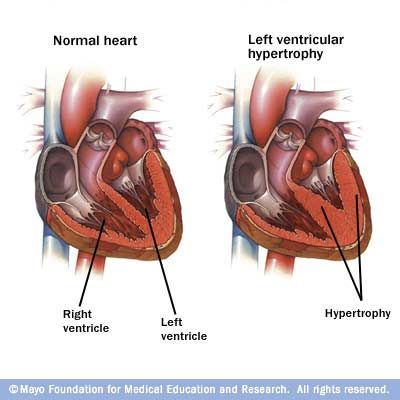 Cardiac Ischemia, Left Ventricular Hypertrophy, Interventional Radiology, Normal Heart, Young Blood, Nursing Tips, Body Tissues, Health Conditions, Heart Health