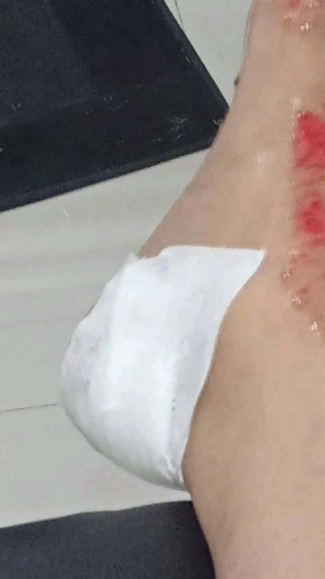 Accident Wallpaper, Injured Leg Snapchat, Pap Jatuh, Leg Bandage Snapchat, Pap Kecelakaan, Sick Prank, Yn Aesthetic, Wound Makeup, Fake Photo Sick