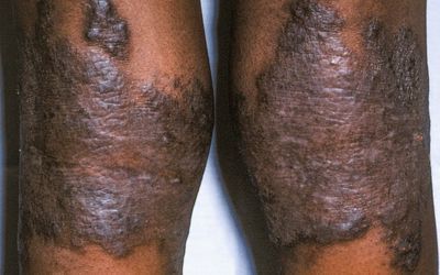 Itchy Legs, Skin Symptoms, White Skin Tone, Hydrocortisone Cream, Skin Patches, Lighter Skin, Skin Discoloration, Itchy Skin, Brown Skin