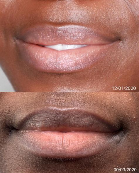 Dr V Lip X Kit after 3 months! Lakisha Adams (@itslakishaa) • Instagram photos and videos Lip Hyperpigmentation, Regrow Hair Naturally, Regrow Hair, Skin Secrets, Fade Dark Spots, Skin Complexion, After 3, Lip Mask, After Photos