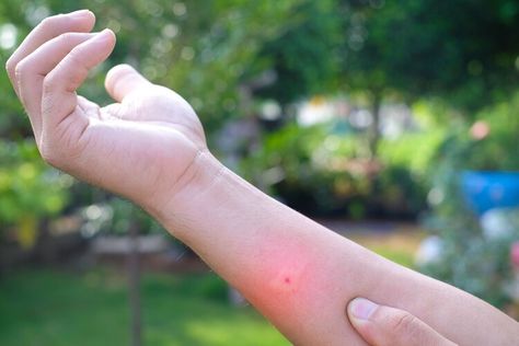 How Is a Wasp Sting Treated? How To Treat A Wasp Sting, Red Wasp Sting, Wasp Sting Remedy, Wasp Sting, Remedies For Bee Stings, Red Wasps, Healing Spices, Natural Immune Support, Wasp Stings