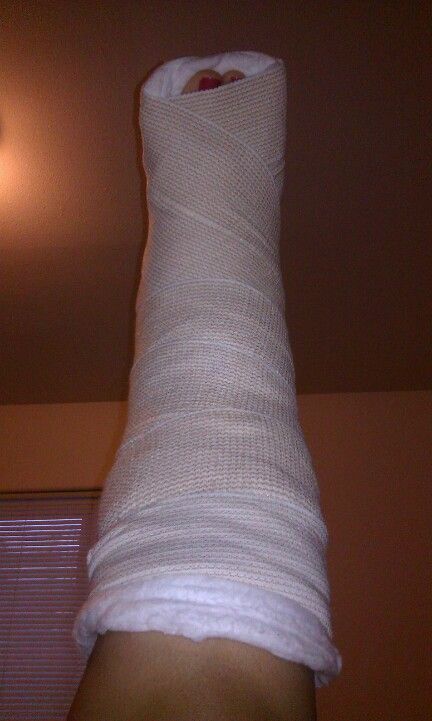 Day 4 (Sunday), still in my ankle splint with ace bandage.  Had to up the Percoset dose...2 every 4 hours now.  Go away pain!!! Leg Bandage Snapchat, Ace Bandage, Hospital Admit, Broken Ankle, Leg Injury, Broken Arm, Hospital Photos, Brown Nails, 4 Hours