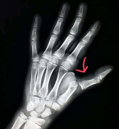 #Xray of the #hand shows a #dislocated #thumb in a #child who #fell off a #swing set. #radiologist #radiology #trauma #injury Broken Thumb, Birthday Quotes For Her, Radiology, Swing Set, The Hand, X Ray, Birthday Quotes, A Child, Okay Gesture