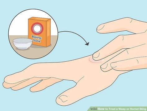 3 Ways to Treat a Wasp or Hornet Sting - wikiHow Red Wasp Sting, Wasp Stings Relief, Wasp Sting Remedy, Hornet Sting, Wasp Sting, Red Wasps, Sting Relief, These Things Happen, Wasp Stings