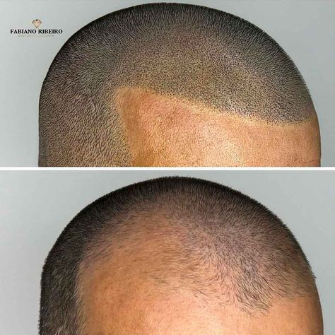 Does Scalp Micropigmentation Hurt? What to Expect Scalp Micropigmentation Women, Scalp Micropigmentation, Celebrity Plastic Surgery, Beauty Clinic, Man Images, Cosmetic Procedures, Bring Up, Hair Follicle, Plastic Surgery