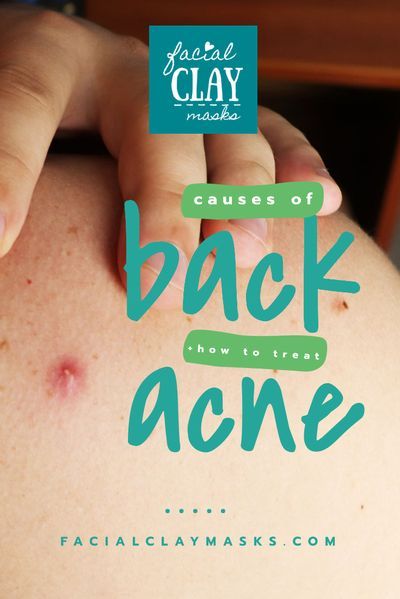 Back Acne Causes, What Causes Pimples, Back Pimples, Back Acne Remedies, Back Acne, Forehead Acne, Pimples Under The Skin, Acne Overnight, Pimples Remedies