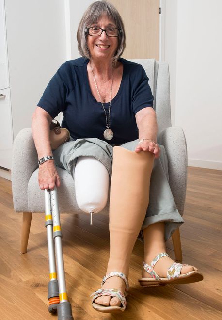 Stella Benson from Hove has lost all her fingers, and had her legs amputated below the knee as a result of sepsis Below The Knee Amputation, Health And Social Care, Social Care, The Warning, Warning Signs, Health Services, The Knee, Did You Know, Self Care