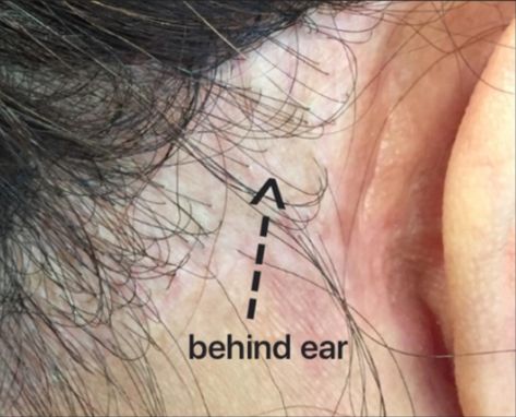 Frontal Fibrosing Alopecia (FFA) — Donovan Hair Clinic Frontal Fibrosing Alopecia, Hair Clinic, Hair Blog, Ffa, Ear Tattoo, Behind Ear Tattoo, Tattoos, Hair