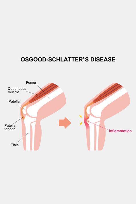 Osgood Schlatter Disease, Knee Pain Stretches, Tooth Nerve, Vitamins For Nerves, Inner Knee Pain, Swollen Knee, Knee Pain Exercises, Nerve Pain Relief, Sciatic Nerve Pain