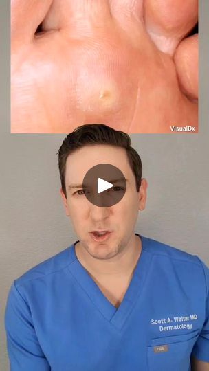 14K views · 330 reactions | Do you have a wart or callus? Here's two ways to help tell the difference and what you can do to treat pesky warts at home!

#warts #wart #callus #wartremoval #warttreatment #verruca #dermatologist #howto #whatsonmyskin #todayilearned

Find all of my favorite hand picked products here:
https://www.amazon.com/shop/denverskindoc
https://shopmy.us/denverskindoc
(affiliate links)

Scott Walter MD, FAAD is a board certified dermatologist practicing in Golden, Colorado.

The content presented in this video is intended for informational and educational purposes only. It is not intended to be a substitute for professional medical advice, diagnosis, or treatment. Always seek the advice of your physician or other qualified health provider with any questions you may have r Planters Wart, Golden Colorado, Walter Scott, Medical Research, Medical Advice, What You Can Do, Affiliate Links, Hand Picked, Skincare Routine