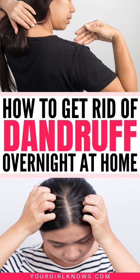 How To Remove Dandruff, Natural Dandruff Remedy, Wellness Garden, Itchy Flaky Scalp, Hair Mask For Dandruff, Home Remedies For Dandruff, Dandruff Solutions, Overnight Hair Mask, Rid Of Dandruff