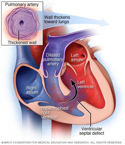 Heart holes are one of the congenital cardiac-disorder. In heart, when there is a hole present in septa on the upper two chambers, then it is called ‘Atrial Septal Defect (ASD) whereas if there is hole in the two lower chambers then it is called ‘Ventricular Septal Defect (VSD). Cardiac Sonography, Nclex Study Plan, Atrial Septal Defect, Nursing Mnemonics, Congenital Heart Defect, Heart Defect, About Heart, Congenital Heart, Heart Function