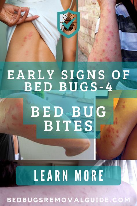 You will not notice bed bugs biting you. During the bite, a natural anesthetic is injected into your skin. It takes up to a day for the bites to become visible. Bite marks from bed bugs resemble mosquitoes, fleas, and other insects. This makes them difficult to detect at first. Several characteristics make bed bug bites unique. 👉 Learn more. Itchy Bug Bite Remedy, Bed Bugs Bites, Bed Bug Bites Remedies, Bed Bug Bites Pictures, Bed Bug Remedies, Bed Bugs Pictures, Itchy Bug Bites, Remedies For Mosquito Bites, Signs Of Bed Bugs