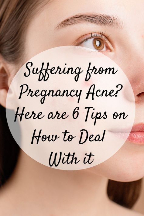 Suffering from Pregnancy Acne? Here are 6 Tips on How to Deal With It Breaking Out On Chin, Pregnancy Acne, How To Clear Pimples, Acne Diet, Forehead Acne, Pregnancy Bump, Pregnancy Hormones, Severe Acne, Hormonal Acne