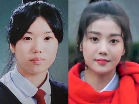 South Korean Plastic Surgery, Kpop Plastic Surgery, Jaw Reduction Surgery, V Line Surgery, Plastic Surgery Fail, Korean Plastic Surgery, Face Surgery, Plastic Surgery Gone Wrong, Cheek Fillers