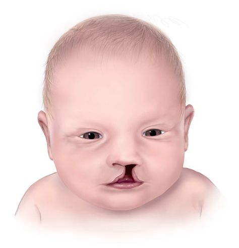 Wolf-Hirschhorn syndrome: MedlinePlus Genetics Patau Syndrome, Cleft Lip And Palate, Feeding Therapy, Cleft Palate, Case Presentation, Cleft Lip, Facial Surgery, Healthy Eyes, Medical Design