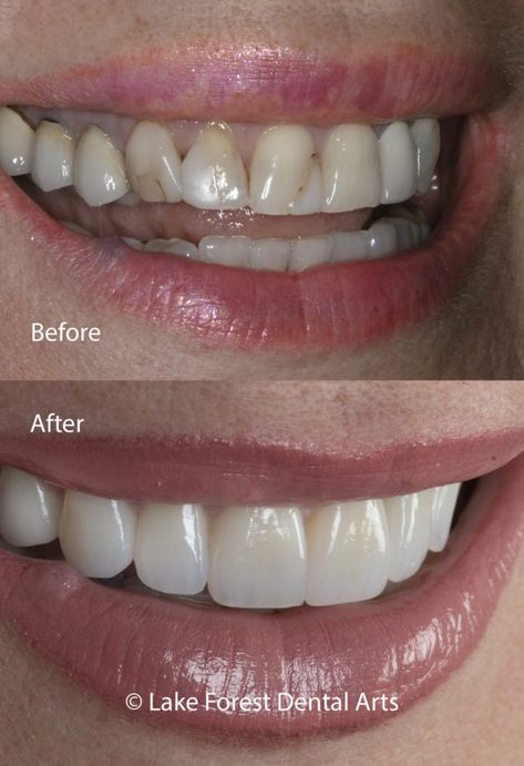 Zirconia crowns before and after Cosmetic Dentistry Before And After, Dental Veneers Before And After, Teeth Veneers Before And After, Veneers Before And After, Teeth Makeover, Dental Makeover, Cosmetic Dentistry Veneers, Veneers Teeth, Aesthetic Dentistry