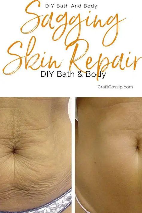 10 Tricks To Tighten Your Skin After Weightloss – Bath and Body Belly Skin Tightening, Sagging Belly, Tighten Stomach, Sagging Cheeks, Natural Skin Tightening, Loose Belly, Tighten Loose Skin, Saggy Skin, Loose Skin