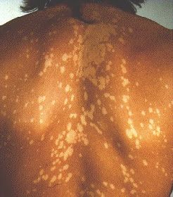 Fungal Rash, Tinea Versicolor, Homeopathy Medicine, Homeopathic Remedies, Microbiology, Homeopathy, Health Science, Health Remedies, Skin Health